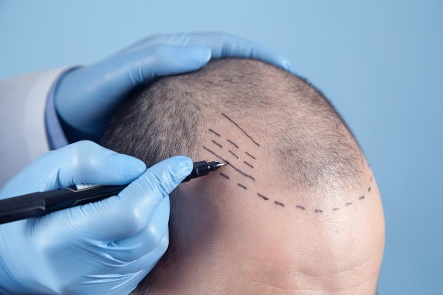 hair transplant in Navi Mumbai