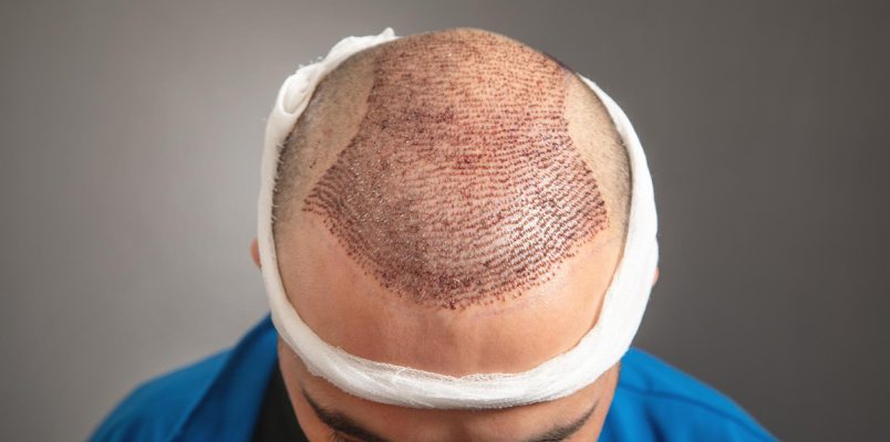 Dermatology-And-Hair-Transplant2